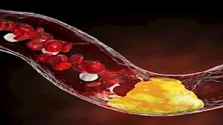 احذر.. أعراض ارتفاع الكوليسترول في رمضان