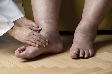 علاج تورم القدمين عند كبار السن- طبيب يحذر: عرض لهذه الأمراض