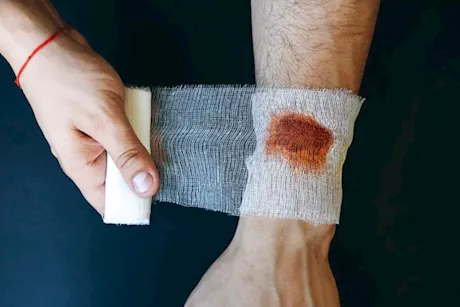 بطء التئام الجروح- طبيب: علامة على نقص هذه الفيتامينات