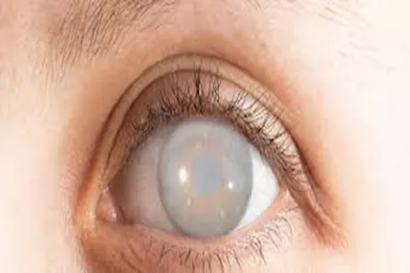 إعتام عدسة العين مقابل الجلوكوما.. ما الفرق بينهما؟