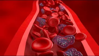 لا تفعلها في أيام العيد.. 6 عادات يومية تزيد خطر الجلطات  