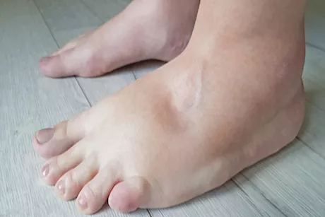 ما هي أسباب احتباس السوائل عند الشباب؟