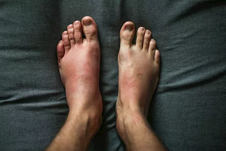 سبب تورم القدمين لمريض الضغط- طبيب يوضح الأمراض المحتملة