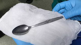استخراج ملعقة من معدة فتاة في المنوفية