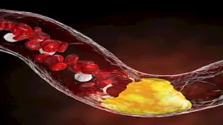 علامة قد تظهر على الذراع قبل النوم تكشف ارتفاع الكوليسترول.. انتبه لها