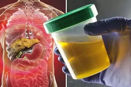 لون البول والكبد- طبيب يحذر: تغيره لهذا الشكل علامة على مرضه