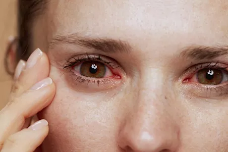 حرقان العين مع دموع- طبيب يوضح أبرز الأسباب وكيفية العلاج