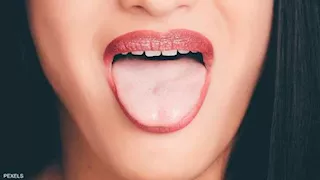 احترس.. تنميل اللسان المستمر علامة لهذه المشكلات الصحية