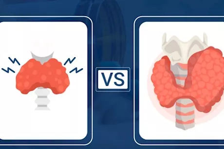  فرط نشاط الغدة الدرقية وخمولها- حسام موافي يوضح الفرق بينهما
