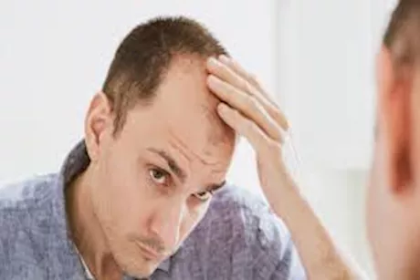 هل هناك علاقة بين الصلع عند الرجال والخصوبة؟