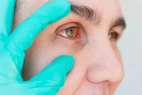 جهاز جديد للعين يقلل عدد الحقن الشهرية لمرضى الوذمة البقعية السكرية