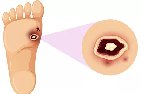 مضاعفات السكر- طبيب: هؤلاء أكثر عرضة للإصابة بالقدم السكري "فيديو"