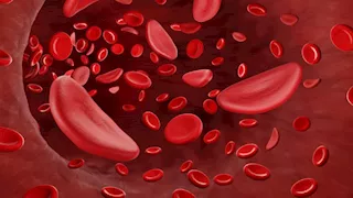 9 أعراض تكشف إصابتك بفقر الدم.. وإليك أسبابه 