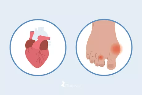 القلب والقدمين- 6 أعراض تظهر عليهما تكشف عن النوبة القلبية