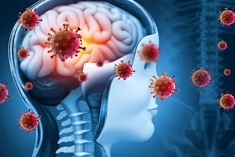 انتشار الالتهاب السحائي في مصر- ما حقيقة هذا الأمر؟ "فيديوجرافيك"