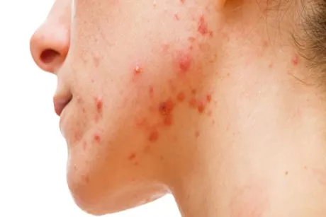 من حب الشباب إلى الالتهابات.. طبيب يحذر من أطعمة ضارة بصحة البشرة