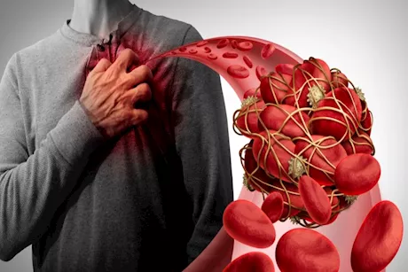 كيف تعرف إصابتك بـ الجلطة؟.. طبيب يوضح الأعراض الأولية