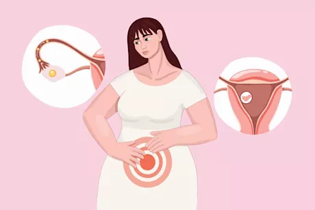 ضعف التبويض عند النساء- طبيب يوضح أسبابه في سن العشرين "فيديو"