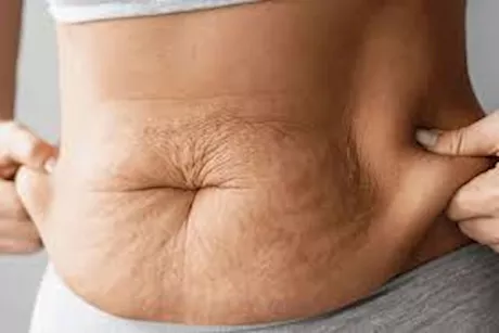 هذا سبب ترهل البطن عند النساء.. إليكِ طريقة التعامل معه