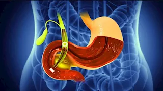  في رمضان.. 6 طرق فعالة للحفاظ على صحة المرارة