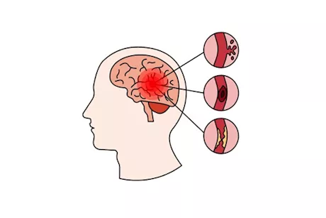 أسباب السكتة الدماغية- طبيب يوضح العوامل المؤدية لهذا المرض "فيديو"