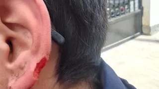 زميله عضه في الفصل.. طالب يفقد جزءًا من أذنه في مدرسة بالإسكندرية 