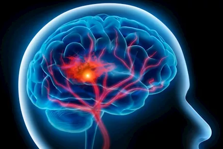 ثالث سبب للوفاة في مصر- كيف تتعامل مع السكتة الدماغية؟ "فيديوجرافيك" 