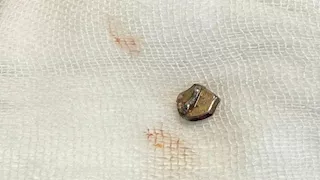 بعد 10 أيام من العذاب.. إنقاذ طفلة ابتلعت "سوستة" بمستشفى بني سويف الجامعي