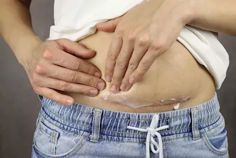 تدليك ما بعد الولادة القيصرية.. إليك ما يجب معرفته