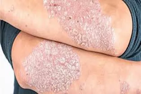 سوء النظافة تسبب الإصابة بالصدفية- حقيقة أم خرافة؟