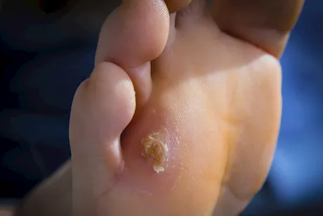 هذه أسباب ظهور مسامير  القدم.. إليك نصائح للوقاية منها