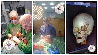 إنقاذ طفلة بعد جراحة دقيقة فى الجمجمة استمرت 4 ساعات 