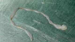 طولها 8 سم.. لن تتوقع ما استخرجه الأطباء من دماغ امرأة