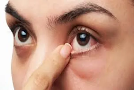طرق التعامل مع مشاكل العين لدى مرضى الفشل الكلوي.. طبيب يوضح
