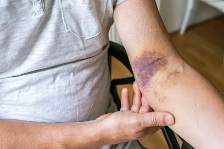 الكدمات المفاجئة في الجسم- إليك الأمراض التي تسببها "فيديوجرافيك"