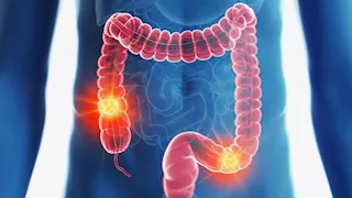  ماذا يحدث لمرضى القولون العصبي بعد تناول الكشري؟.. أخصائي تغذية يوضح
