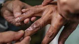 الصحة: مرض الجذام قابل للشفاء.. ومنشورات "أبو زعبل" مضللة