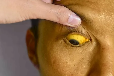 سبب اصفرار الوجه عند كبار السن- هل له دلالات خطيرة؟    