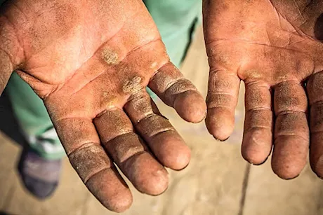 مسمار القدم يصيب اليد أيضًا- 5 عوامل تجعل الكالو يظهر في يديك