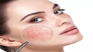 ليست مجرد عروق عابرة.. ماذا تقول الخطوط الدموية الدقيقة على سطح الجلد؟