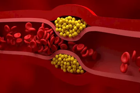 الدهون الثلاثية.. متى تصبح خطرا على القلب وكيف يمكن خفضها؟
