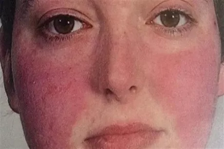 متلازمة احمرار الوجه بسبب المضاد الحيوي فانكومايسين.. ماذا يحدث؟  