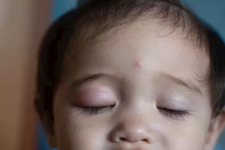 تورم الجفون عند الأطفال- طبيب يكشف أبرز الأسباب والعلاج