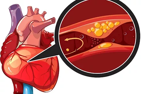 كيف يمكن الوقاية من مرض الشريان التاجي؟- حسام موافي يجيب