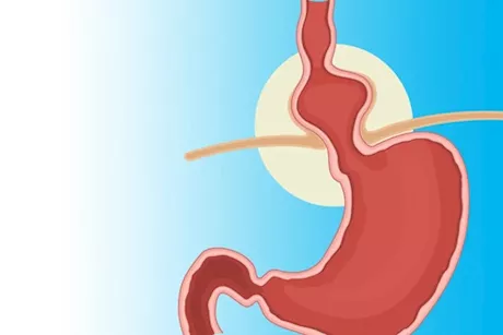 حسام موافي يحذر من هذين العرضين: يكشفان فتق الحجاب الحاجز