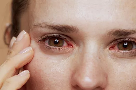هل تعاني من حكة في العينين؟ إليك أفضل الطرق للتخلص منها