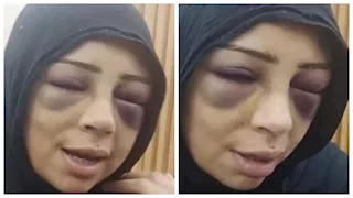 "وشي اتشوّه".. فتاة بورسعيد تكشف تفاصيل اعتداء خطيبها السابق عليها (صور)
