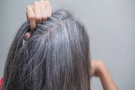ظهور الشعر الأبيض ونقص فيتامين B12- إليك العلاقة بينهما
