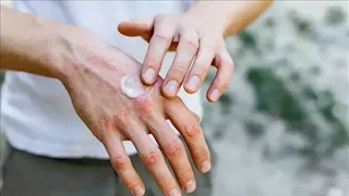 الولايات المتحدة.. سحب عاجل لكريم شهير يعالج اﻷكزيما بسبب تلوثه ببكتيريا خطيرة