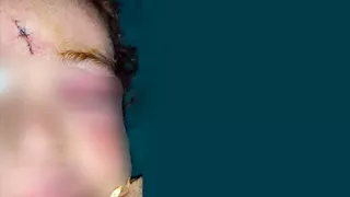 إنقاذ طفل نهشه كلب شرس في المنيا.. وفريق طبي يعيد بناء ملامح وجهه
